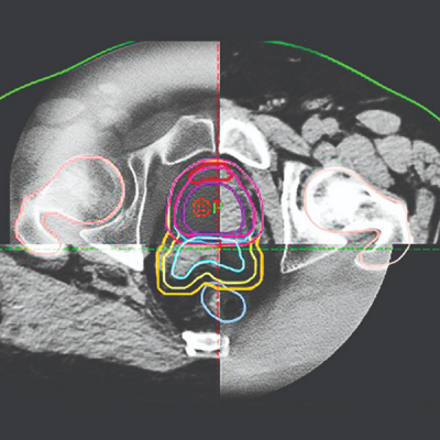 IGRT Radioterapia Guiada por Imágenes Mevaterapia Oncología