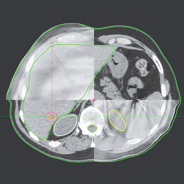 IGRT Radioterapia guiada por imágenes
